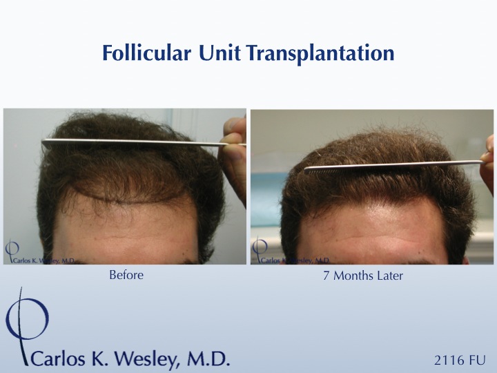 A 2116 graft session in Dr. Wesley practice in NYC.  
Wavy brown hair provides some of the best hair characteristics for more scalp coverage.