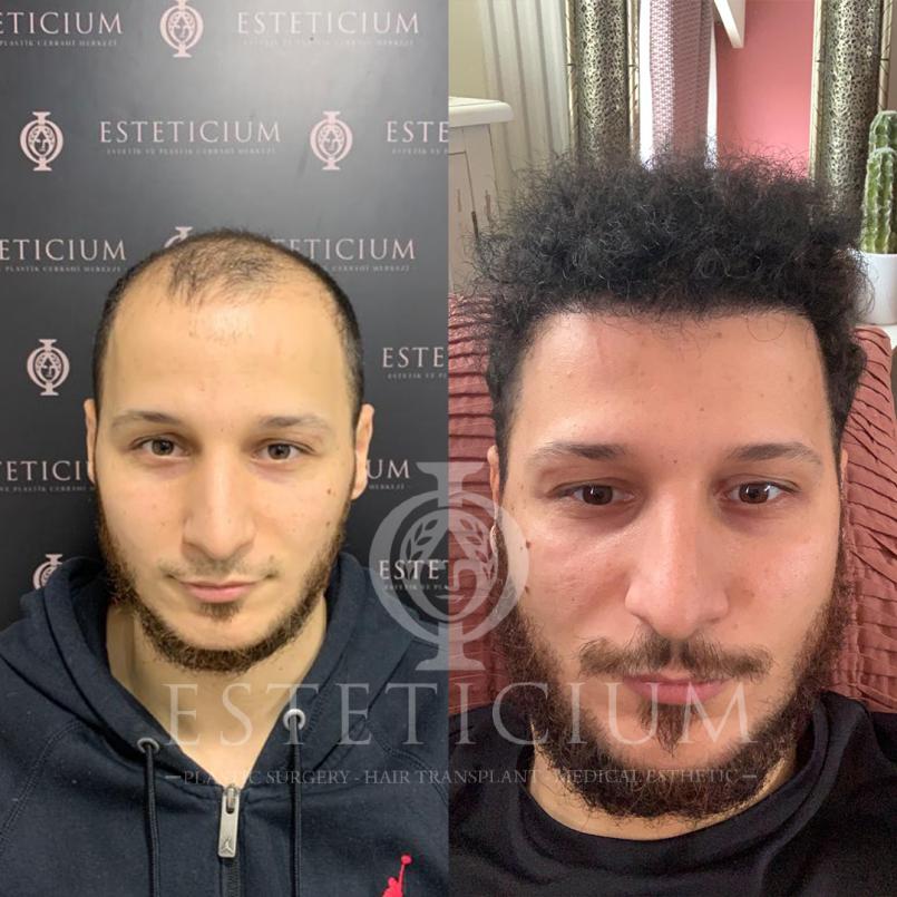 Hair Transplant Before - After