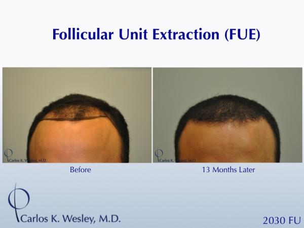 Before and 13 months after FUE with Carlos K. Wesley (NYC).