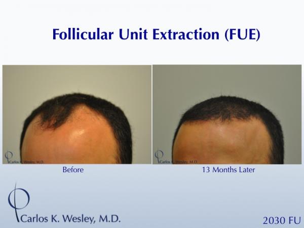 Before and 13 months after FUE with Carlos K. Wesley (NYC).