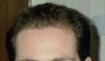 hair 1995 the year before any surgery