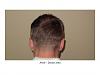 Dr. Paul Shapiro, MD  
FUT  
5207 grafts/ 11,661 hairs 
3 surgical sessions 
12 months post-op session 3