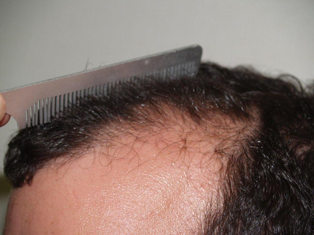 Click image for larger version

Name:	After Hairline.jpg

Size:	93.4 KB
ID:	9013