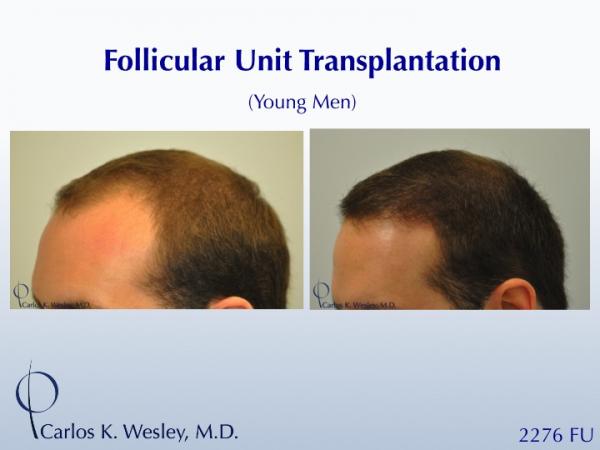 This 28-year-old desired the most natural appearing surgical hair restoration. He elected to have a session with Dr. Carlos K. Wesley in New York...