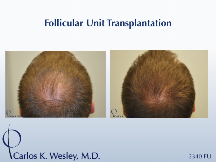 This 25-year-old patient had tried finasteride 1mg (Propecia) prior to his decision to treat his thinning mid scalp with surgical hair restoration....