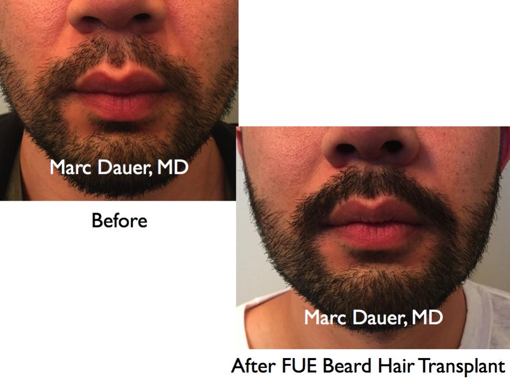 Click image for larger version

Name:	Hair Transplant Slides.637.jpg

Size:	74.4 KB
ID:	40043