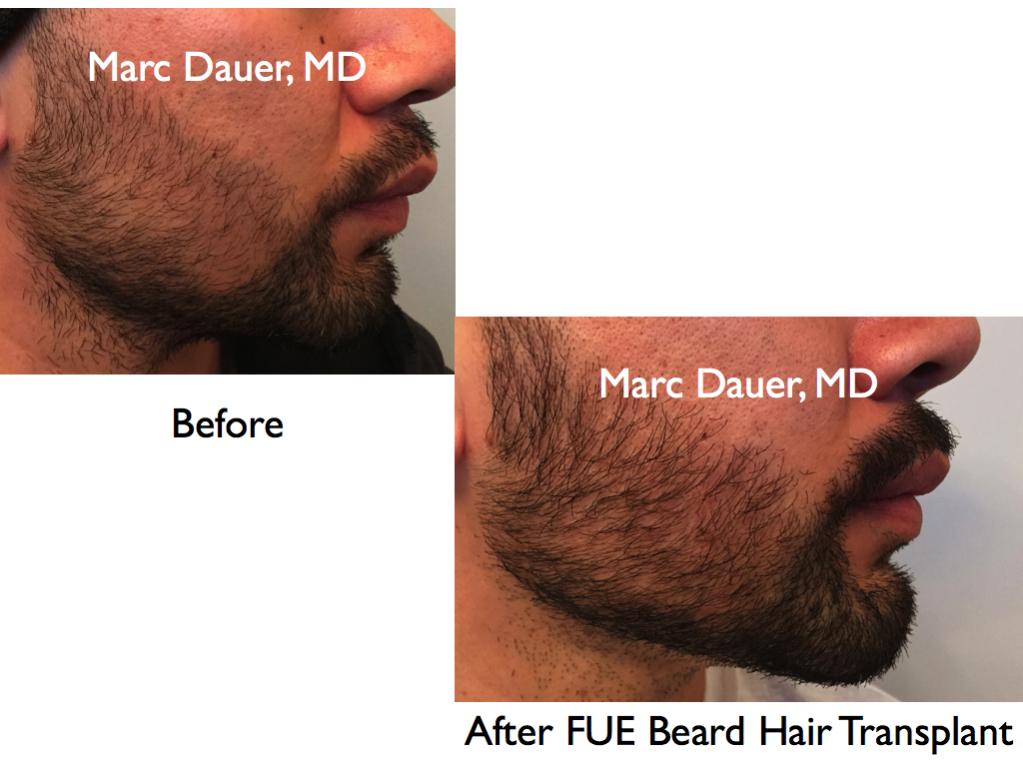 Click image for larger version

Name:	Hair Transplant Slides.638.jpg

Size:	71.6 KB
ID:	40044