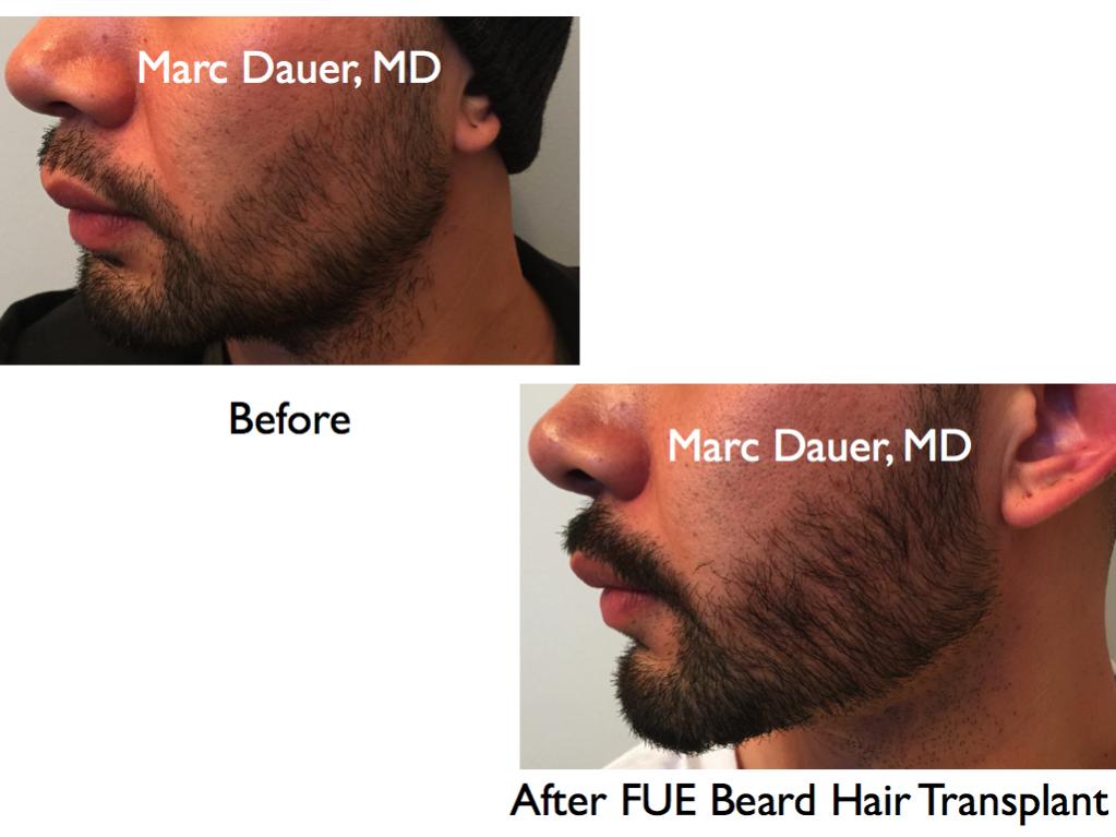 Click image for larger version

Name:	Hair Transplant Slides.639.jpg

Size:	62.8 KB
ID:	40045