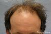 Click image for larger version

Name:	03_before-hair-transplant.jpg

Size:	19.9 KB
ID:	44108