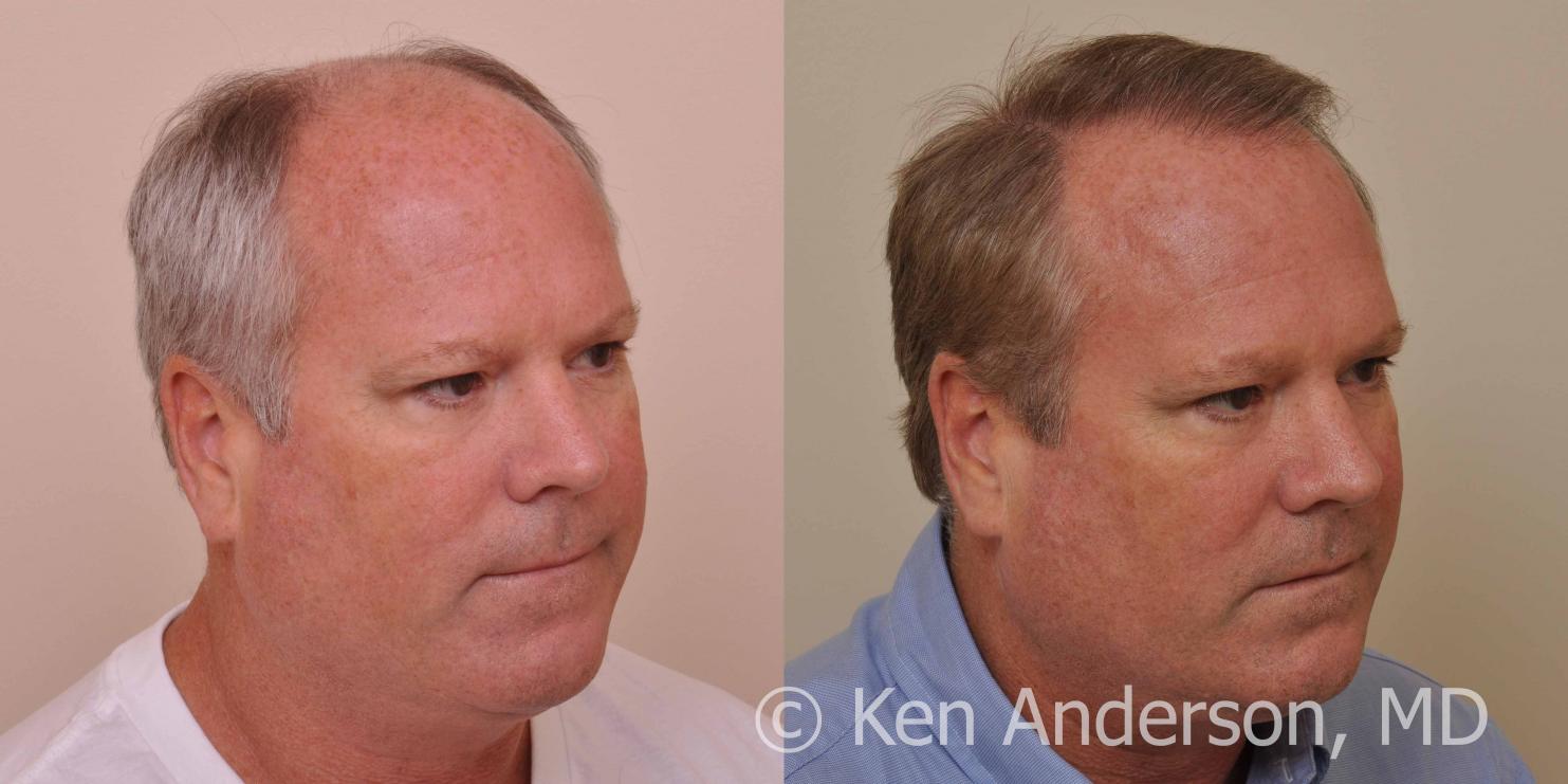 Linear Strip Hair Transplant Results at 6 months - Anderson Center for Hair