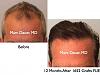 Click image for larger version

Name:	Hair Transplant Slides.539.jpg

Size:	37.1 KB
ID:	38559
