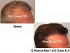 Click image for larger version

Name:	Hair Transplant Slides.540.jpg

Size:	36.0 KB
ID:	38560