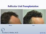 Before/After images of this 50-yr-old patient after a 4250-graft treatment by Dr. Carlos K. Wesley.  
 
A video of his transformation may be viewed...