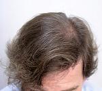 RESULT AFTER ONE FUT OF 1630 FOLLICULAR UNITS