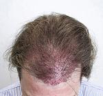 IMMEDIATELY AFTER 1630 FOLLICULAR UNITS PLACED