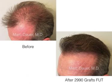 Marc Dauer MD hair transplant results