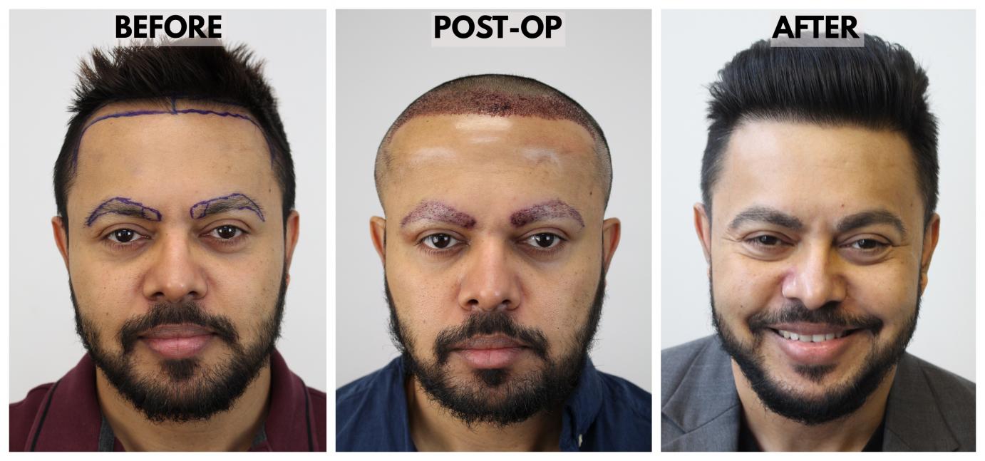 Click image for larger version

Name:	01-Before-Postop-After-Hairline.jpg

Size:	96.6 KB
ID:	72512