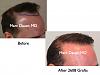 Click image for larger version

Name:	Hair Transplant Slides2.246.jpg

Size:	54.4 KB
ID:	34368