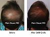 Click image for larger version

Name:	Hair Transplant Slides2.248.jpg

Size:	74.0 KB
ID:	34370