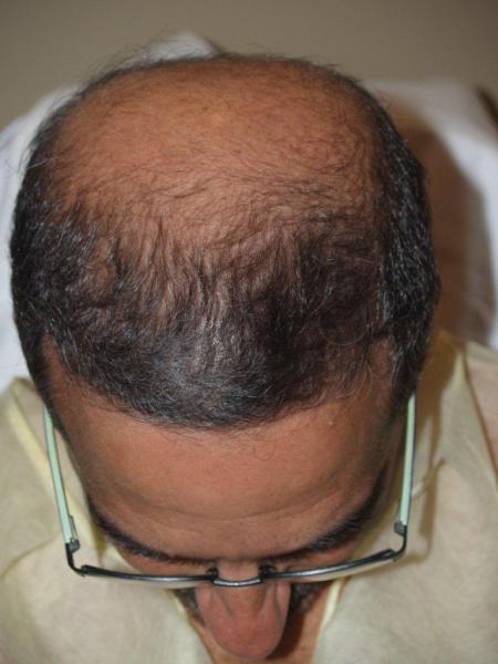 Before Hair Transplant