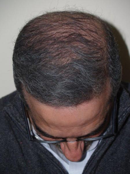 After Hair Transplant