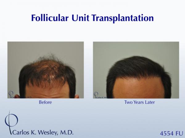 A 42-year-old man had two (2) prior hair transplants with poor results.  He came to Dr. Carlos K. Wesley (NYC) for a repair to create a more natural...