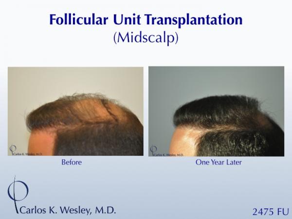 A 42-year-old man had two (2) prior hair transplants with poor results.  He came to Dr. Carlos K. Wesley (NYC) for a repair to create a more natural...