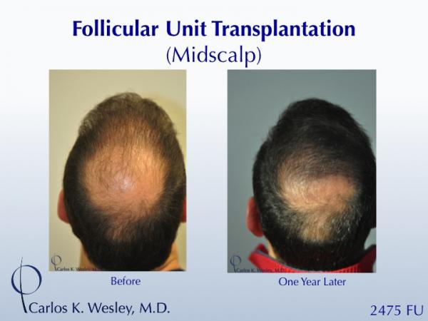 A 42-year-old man had two (2) prior hair transplants with poor results.  He came to Dr. Carlos K. Wesley (NYC) for a repair to create a more natural...