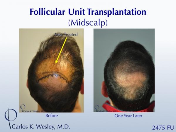 A 42-year-old man had two (2) prior hair transplants with poor results.  He came to Dr. Carlos K. Wesley (NYC) for a repair to create a more natural...