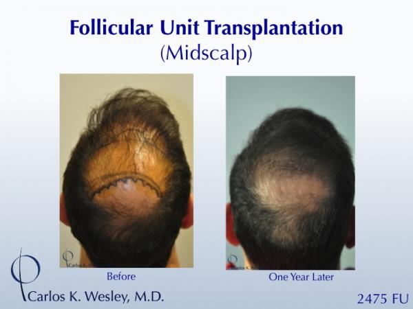 A 42-year-old man had two (2) prior hair transplants with poor results.  He came to Dr. Carlos K. Wesley (NYC) for a repair to create a more natural...