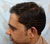 Click image for larger version

Name:	Hair Transplant Side Effect.jpg

Size:	84.4 KB
ID:	55169