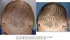 Click image for larger version

Name:	5 Hair loss Progress #3.jpg

Size:	97.4 KB
ID:	36893