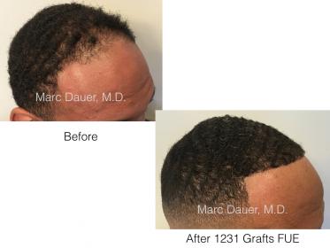 FUE African American Patient