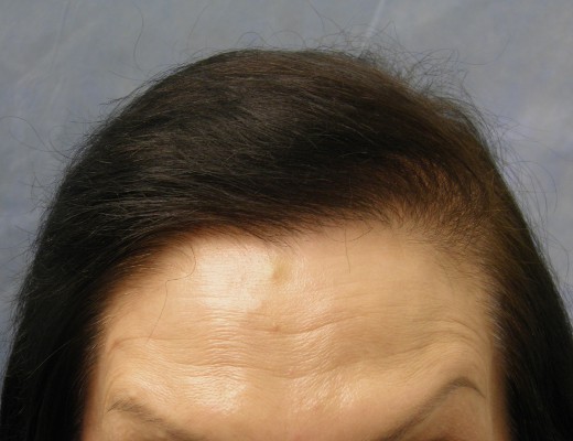 Click image for larger version

Name:	05_after-1st-hair-transplant.jpg

Size:	47.3 KB
ID:	9852