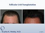 Before/After 2160 grafts 
Dr. Carlos K. Wesley in New York City