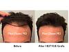 Click image for larger version

Name:	Hair Transplant Slides copy229.008.jpg

Size:	13.5 KB
ID:	49061