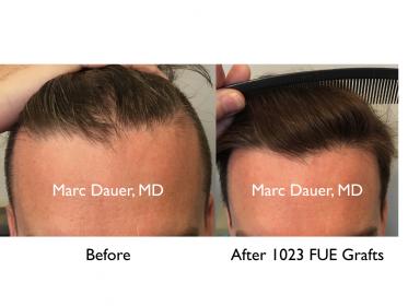 FUE hair transplant by Dr. Marc Dauer