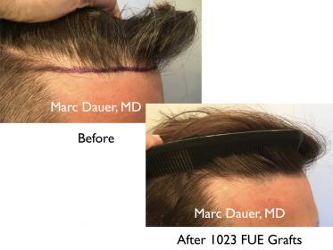 FUE hair transplant by Dr. Marc Dauer