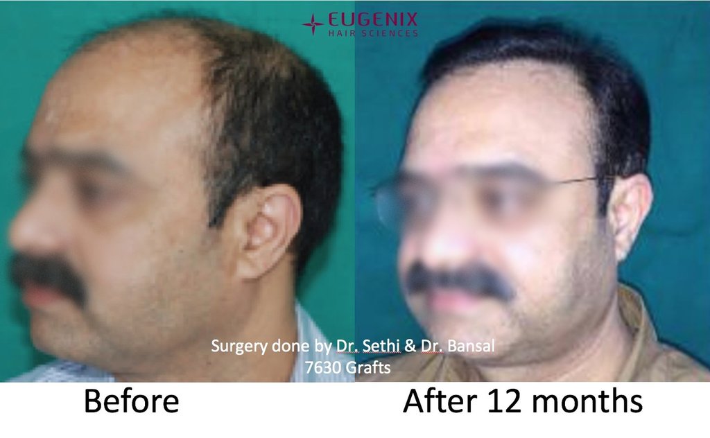 Click image for larger version

Name:	Dr-Pradeep-Sethi-Dr-Arika-Bansal-Eugenix-Result7.jpg

Size:	69.2 KB
ID:	60278