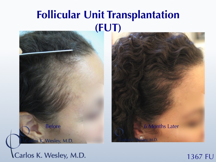 Female Hair Restoration