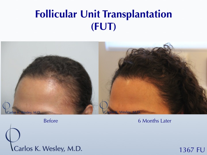 Female Hair Restoration