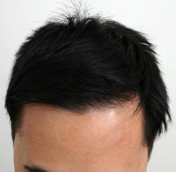 Hairline result after 10 months