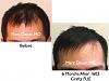 Click image for larger version

Name:	Hair Transplant Slides.521.jpg

Size:	35.7 KB
ID:	38420