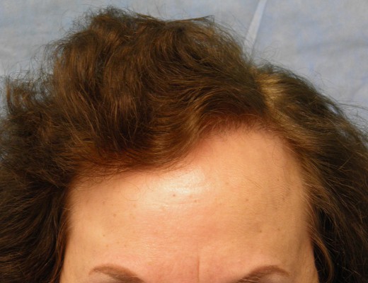 Click image for larger version

Name:	04_after-1st-hair-transplant.jpg

Size:	53.1 KB
ID:	16074