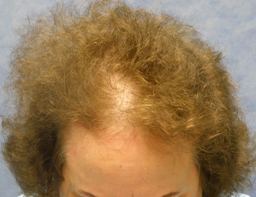 Click image for larger version

Name:	05_before-hair-transplant-top-view.jpg

Size:	61.5 KB
ID:	16075