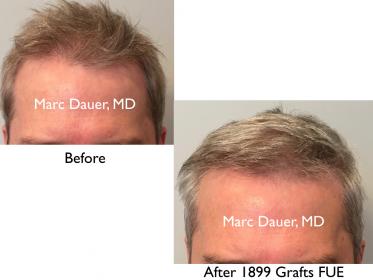 Click image for larger version

Name:	Hair Transplant Slides copy91.001.jpg

Size:	12.5 KB
ID:	47741