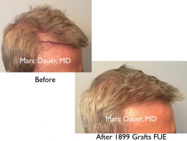 Click image for larger version

Name:	Hair Transplant Slides copy86.001.jpg

Size:	13.1 KB
ID:	47742