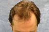 Click image for larger version

Name:	03_before-hair-transplant-top-view.jpg

Size:	52.2 KB
ID:	16132