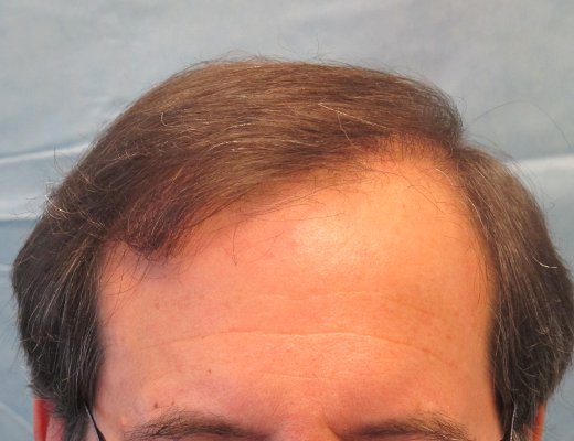 Click image for larger version

Name:	1098_2c_after-hair-transplant.jpg

Size:	42.9 KB
ID:	24516