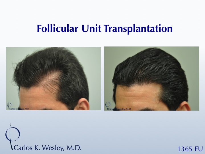 While not every patient is a candidate for this approach, this 46-year-old patient received a smaller, focused session to reinforce his temporal...